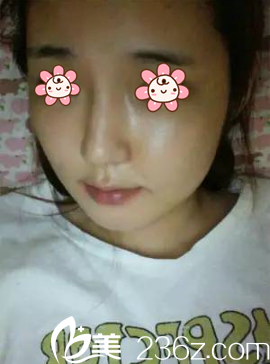 朴正日颧骨缩小加下颌角加垫下巴术后十天 朴正日颧骨缩小加下颌角加垫下巴术后十天