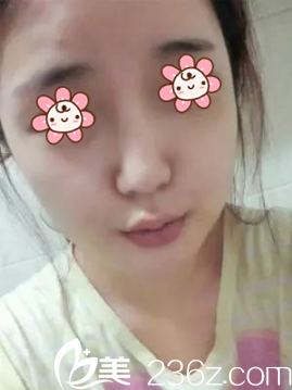 韩国NEO整形外科颧骨缩小+下颌角+垫下巴术后15天 韩国NEO整形外科颧骨缩小+下颌角+垫下巴术后15天