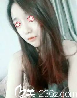 朴正日院长颧骨缩小术后一个月 朴正日院长颧骨缩小术后一个月