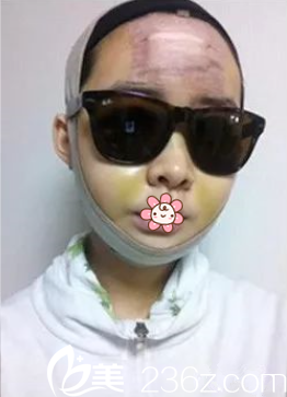 姬广翰双鄂+面部轮廓术后10天 姬广翰双鄂+面部轮廓术后10天