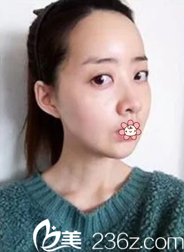 我在重庆美仑美奂做完双鄂+面部轮廓40天 我在重庆美仑美奂做完双鄂+面部轮廓40天