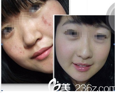 沈培兴医生祛痘案例对比