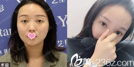 北京艺星医疗美容医院双眼皮+上眼睑松弛案例前后效果对比