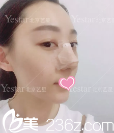 连凯峰鼻综合术后13天效果