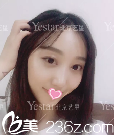 北京艺星连凯峰鼻综合术后13天效果