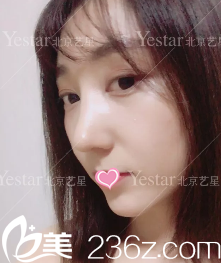 连凯峰鼻综合术后28天效果