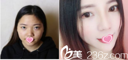 北京东方和谐医疗美容诊所切开双眼皮鼻综合前后对比效果