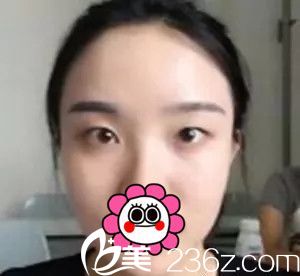 术前单眼皮小眼睛 术前单眼皮小眼睛