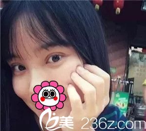 术后一周双眼皮恢复中 术后一周双眼皮恢复中