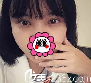 术后十天双眼皮拆线恢复 术后十天双眼皮拆线恢复