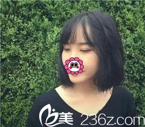 拆完线后双眼皮恢复 拆完线后双眼皮恢复