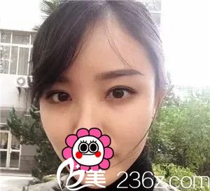 5mm?7mm?9mm? 泰州华美双眼皮亲身体验告诉你想要自然宽双眼皮到底选几毫米合适