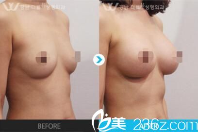 吴赫守胸部整形前后对比