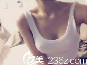 假体隆胸术后2周效果