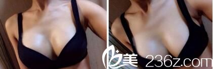 胸部整形术后1个月效果