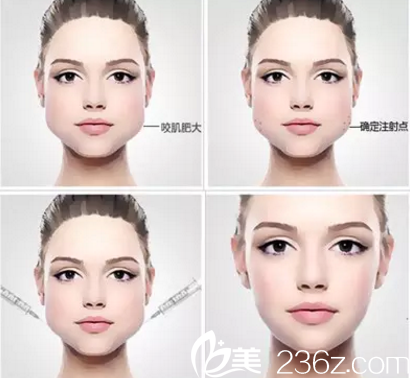 咬肌大造成四方脸？长春铭尚瘦脸除皱瘦脸1100元起