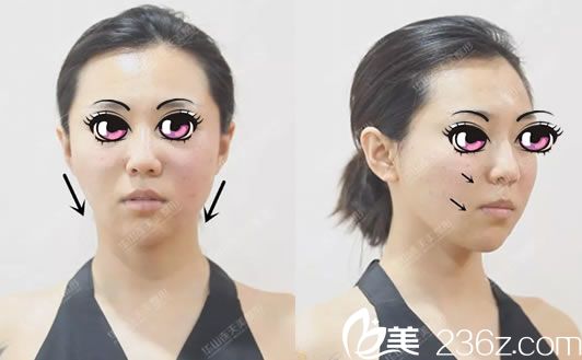 我找<!--<i data=20240703-sp></i>-->做线雕和玻尿酸前 我找<!--<i data=20240703-sp></i>-->做线雕和玻尿酸前