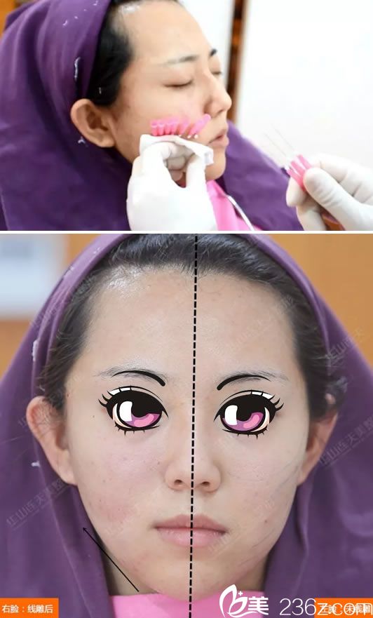 线雕手术过程和做完半张脸效果 线雕手术过程和做完半张脸效果