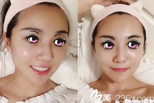 线雕和注射玻尿酸2天恢复效果 线雕和注射玻尿酸2天恢复效果