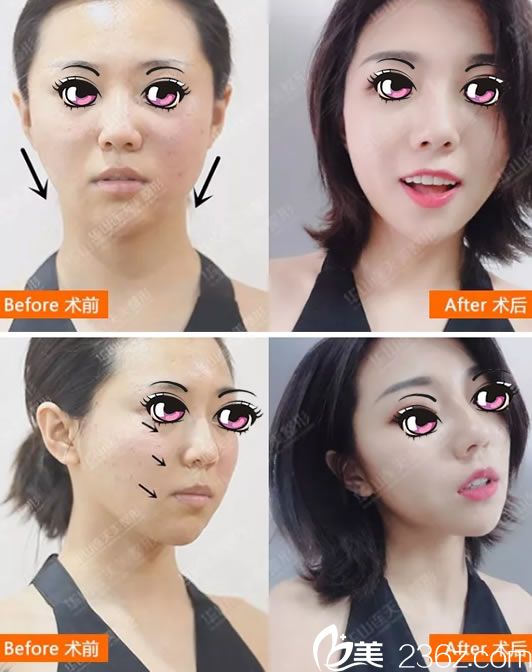 连天美<!--<i data=20240703-sp></i>-->线雕案例对比图 连天美<!--<i data=20240703-sp></i>-->线雕案例对比图