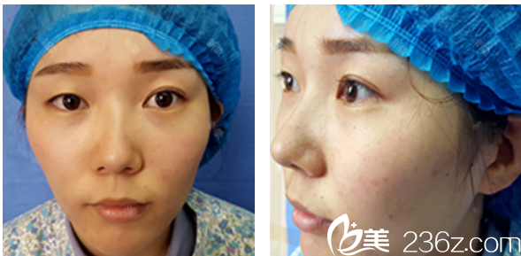 双眼皮术前照片 双眼皮术前照片