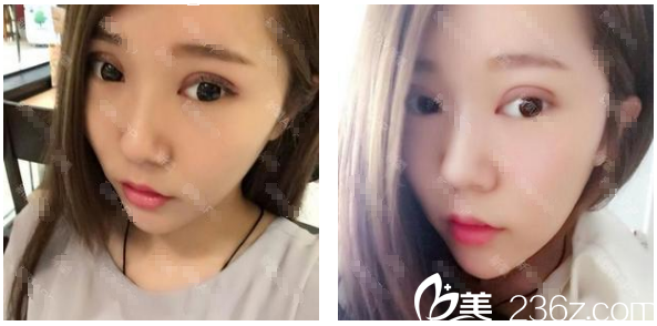 广州华美阮庆玲双眼皮天图片 广州华美阮庆玲双眼皮天图片