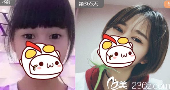 安徽合肥刘冷怎么样？附刘冷双眼皮整形案例对比图