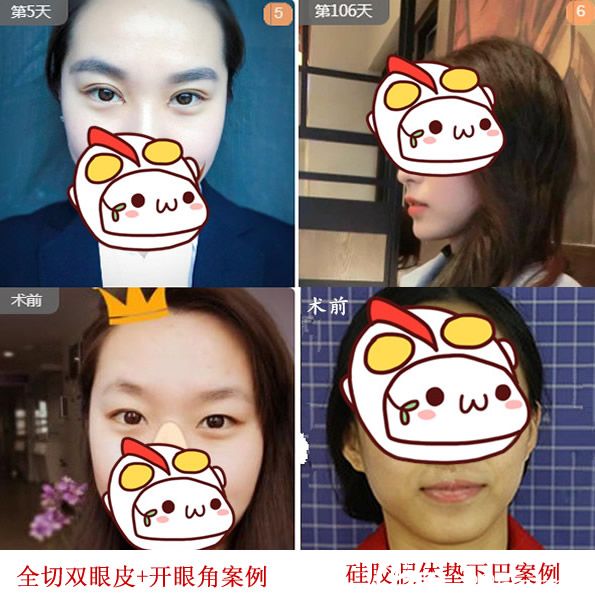 安徽合肥韩美闫品行双眼皮案例+硅胶假体隆下巴案例