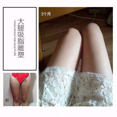 深圳美莱医疗整形美容医院大腿吸脂案例对比图