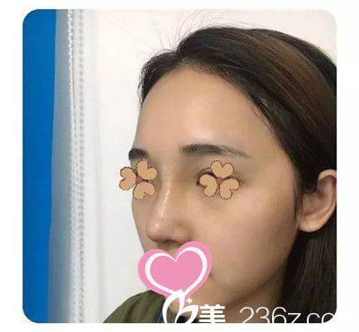 假体隆鼻后一个月效果