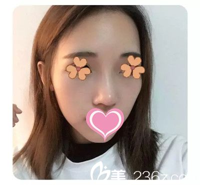 李迎春医生隆鼻案例