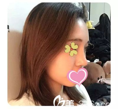 隆鼻后三个月恢复效果