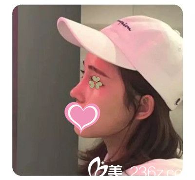 李迎春给我做隆鼻手术四个月了