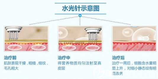 德玛莎注射原理 德玛莎注射原理