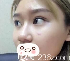 假体隆鼻术前照 假体隆鼻术前照