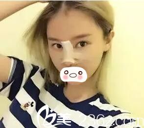 鼻综合整形当天照 鼻综合整形当天照