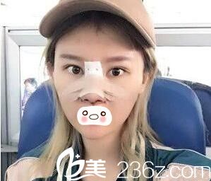 鼻整形术后5天<span style= 鼻整形术后5天<span style=