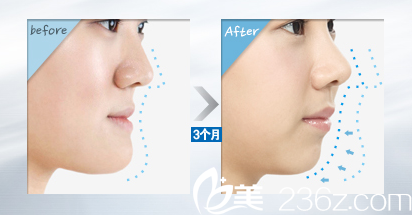 柳相旭院长双颚手术前后对比 柳相旭院长双颚手术前后对比