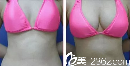 太原欧美莲自体脂肪隆胸效果图