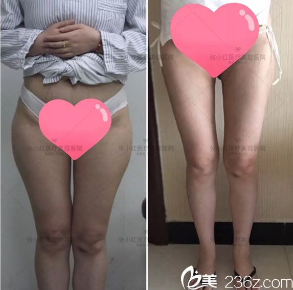 做运动减肥失败,义乌张小红侍医生选择腿部抽脂减肥手术25天后效果纪实