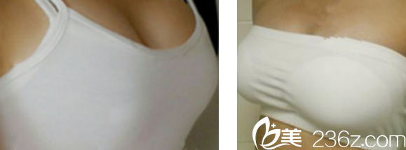 胶假体隆胸第20天恢复图片 胶假体隆胸第20天恢复图片