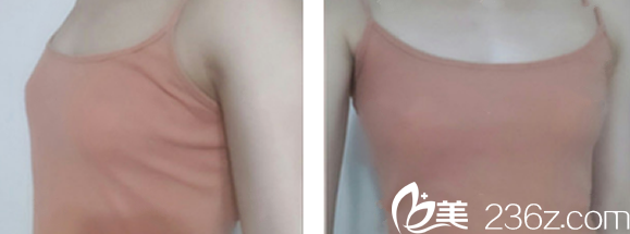 兰州崔大夫整形隆胸前 兰州崔大夫整形隆胸前