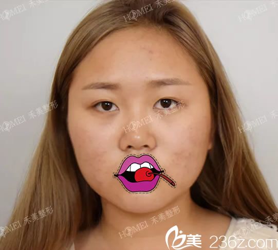 在嘉兴禾美做双眼皮手术前 在嘉兴禾美做双眼皮手术前