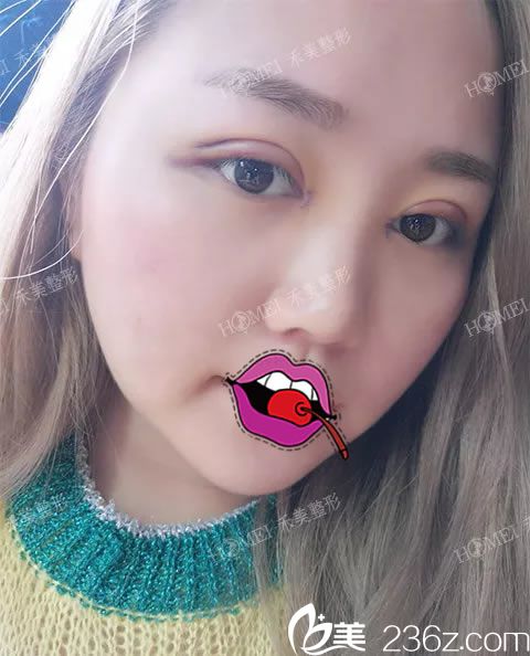 在嘉兴禾美做完双眼皮2天后 在嘉兴禾美做完双眼皮2天后