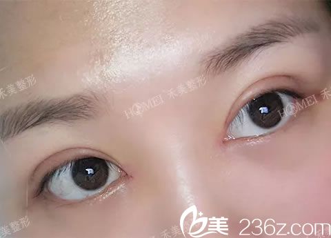 嘉兴禾美做双眼皮7天拆线照 嘉兴禾美做双眼皮7天拆线照