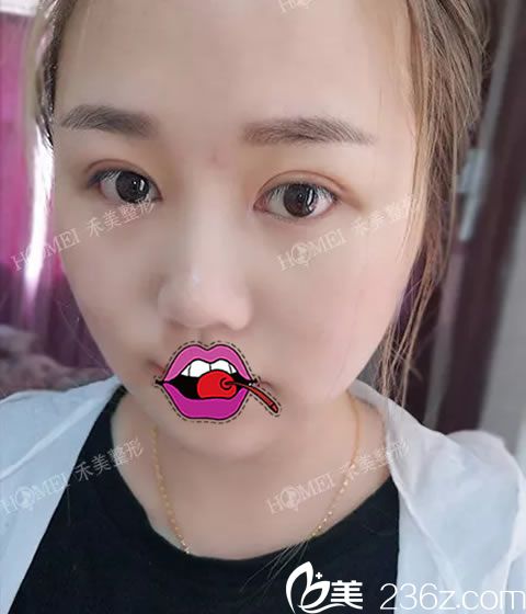 双眼皮和开眼角做完10天效果 双眼皮和开眼角做完10天效果