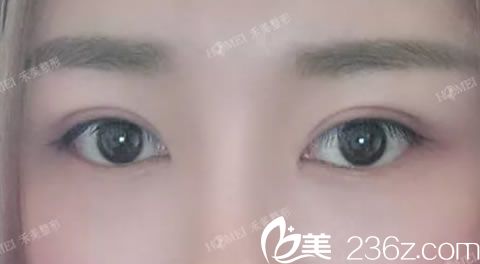 选择嘉兴禾美周宇丹做双眼皮效果 选择嘉兴禾美周宇丹做双眼皮效果