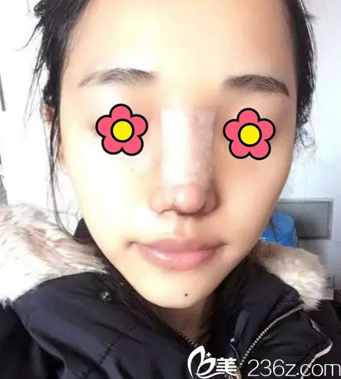 在台州爱莱美刚做完隆鼻手术照片