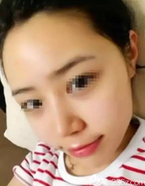 注射玻尿酸填充术后两天