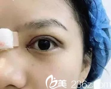 张志宏医生双眼皮手术案例